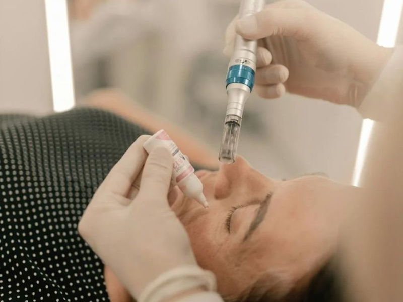 Фракційна мезотерапія: чим вона відрізняється від ін'єкційної — і що обрати?