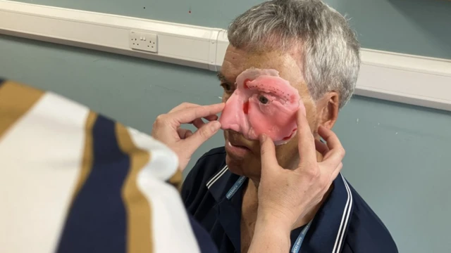 У Британії для постраждалого в аварії велосипедиста надрукували на 3D-принтері частину обличчя
