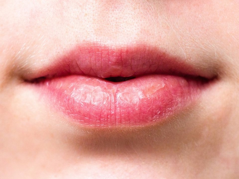 Що робити, якщо сохнуть губи: 5 корисних порад